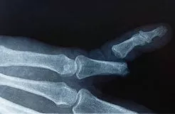 What is Complex Fracture? Causes and Treatment