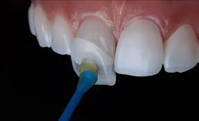 Can Teeth Capping Fix Broken or Chipped Teeth? A Complete Guide for Patients